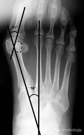 踇外翻畸形（Hallus valgus）