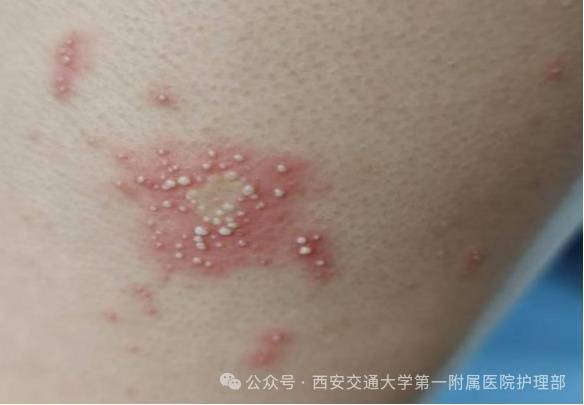 西安多区发现隐翅虫？千万别拍<strong></p>
<p>稳理财</strong>！毒液堪比硫酸