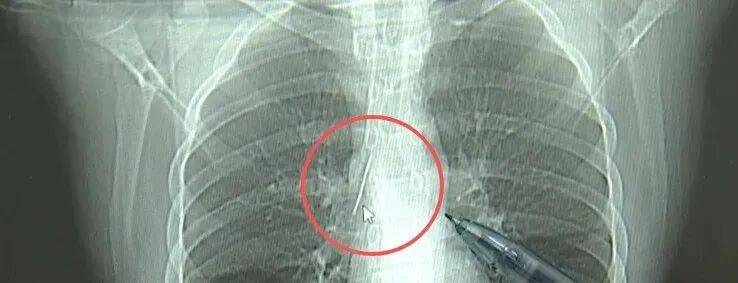 17岁小伙参军体检发现胸腔内有根5cm缝衣针<strong></p>
<p>理财书籍推荐</strong>，父母回忆或是1岁时扎入，取出时已锈迹斑斑