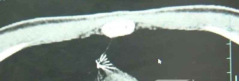 17岁小伙参军体检发现胸腔内有根5cm缝衣针<strong></p>
<p>理财书籍推荐</strong>，父母回忆或是1岁时扎入，取出时已锈迹斑斑