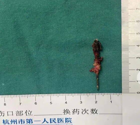 17岁小伙参军体检发现胸腔内有根5cm缝衣针<strong></p>
<p>理财书籍推荐</strong>，父母回忆或是1岁时扎入，取出时已锈迹斑斑