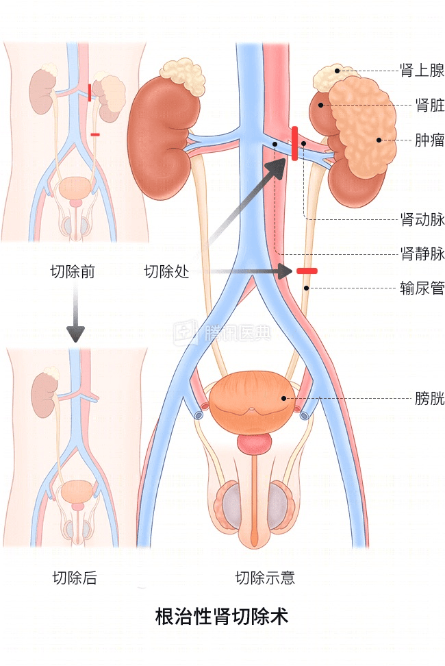 “感觉天塌了”！深圳女孩5岁患癌<strong></p>
<p>30万理财</strong>，爸妈决定：为她冻存卵巢组织